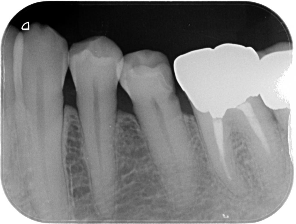 虫歯治療前　40_2