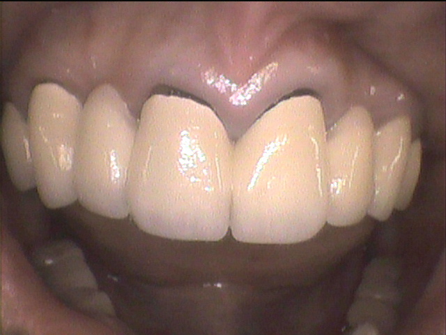 インプラント治療前　42_1