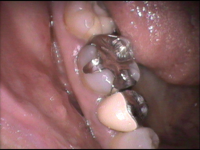 インプラント治療前　43_1