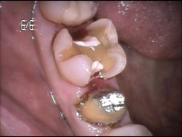 虫歯治療中　43_4