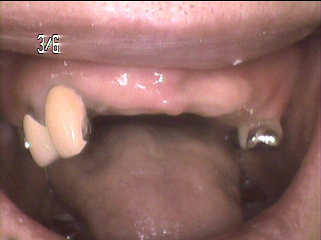 虫歯治療中　45_3