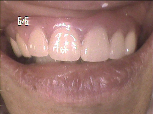 虫歯治療後　45_5
