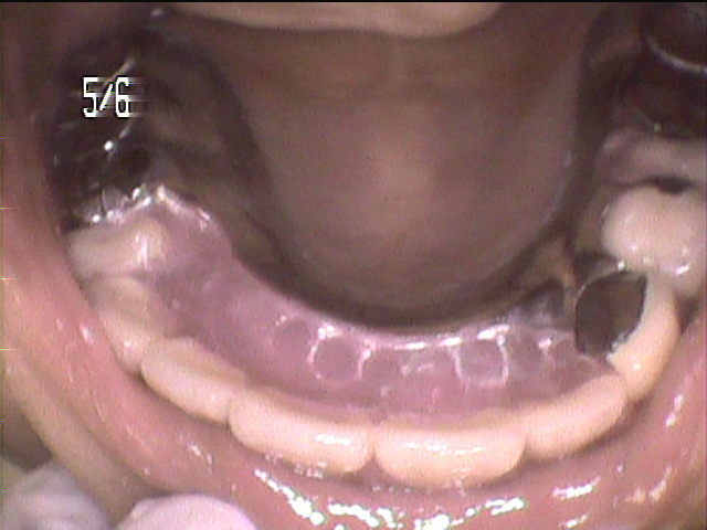 虫歯治療後　45_6