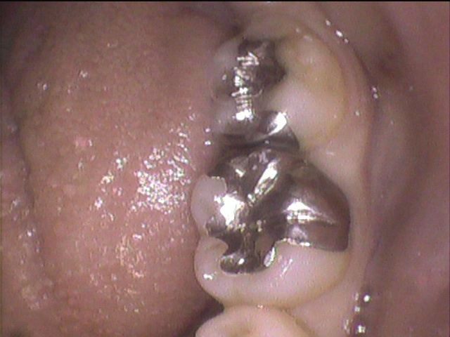 インプラント治療前　46_1