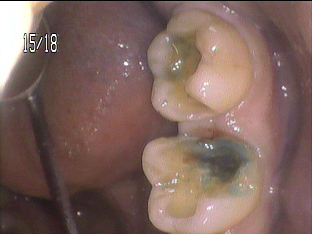 虫歯治療中 46_3