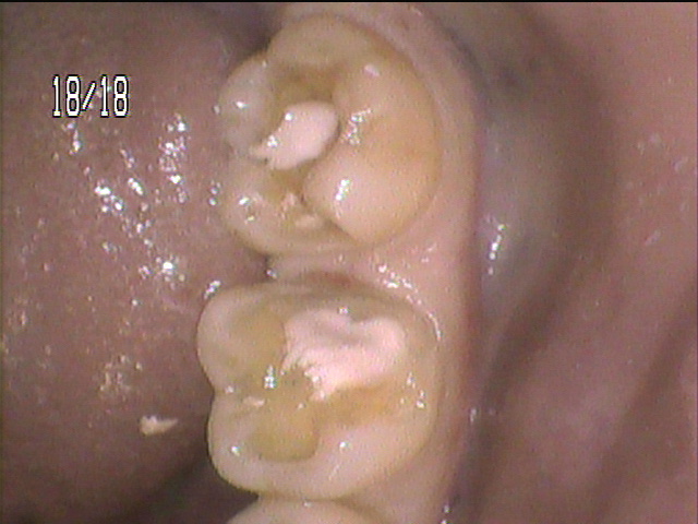 虫歯治療中 46_4