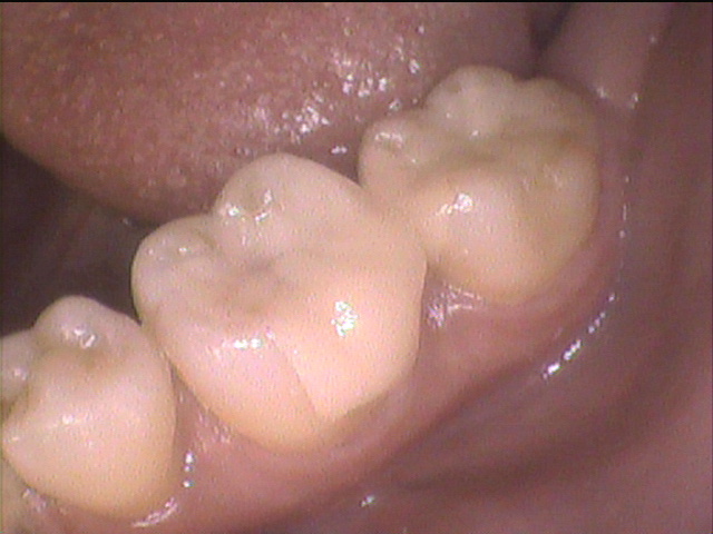 虫歯治療後 46_5