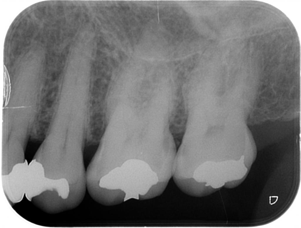 虫歯治療前　5_2