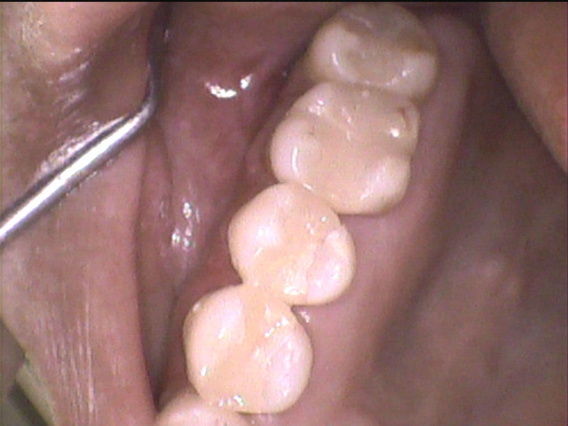 虫歯治療後　5_5