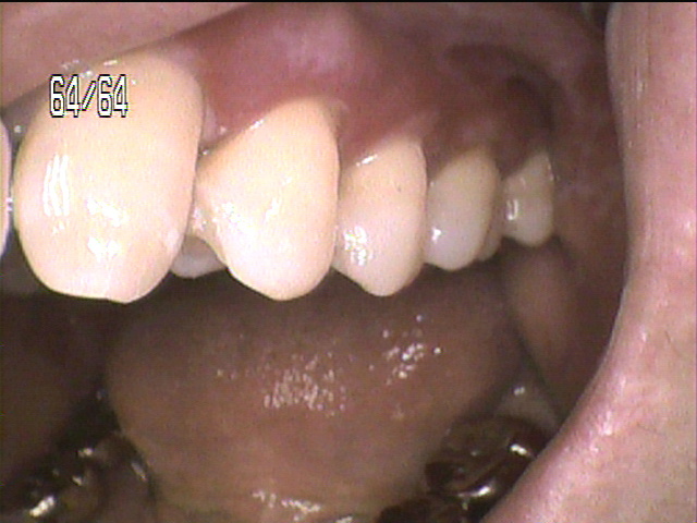 虫歯治療後　5_6