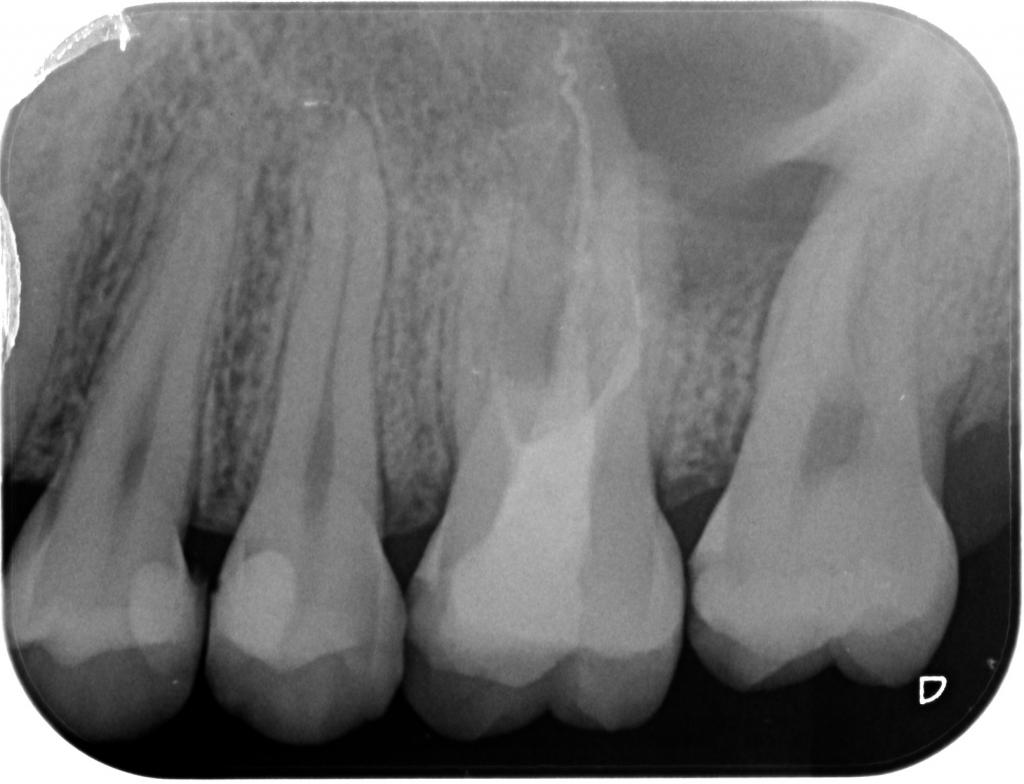 虫歯治療前　6_2