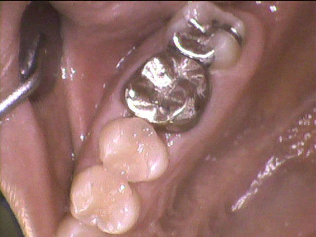 虫歯治療後　6_5