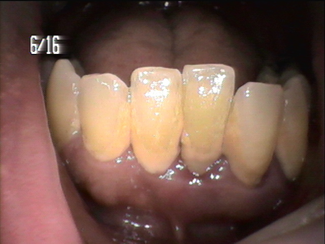 歯周病治療前　1_1