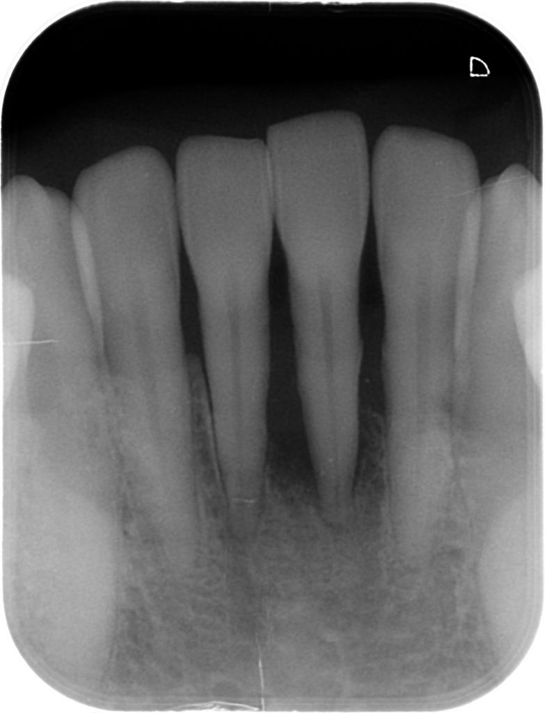歯周病治療前　1_2