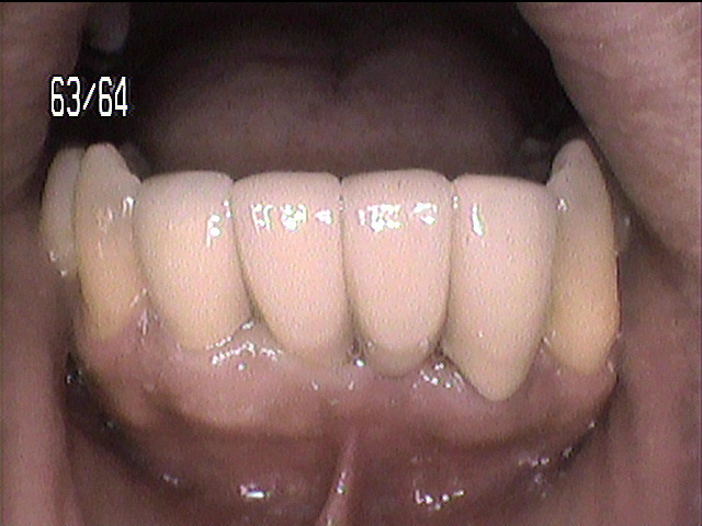 歯周病治療後　1_5