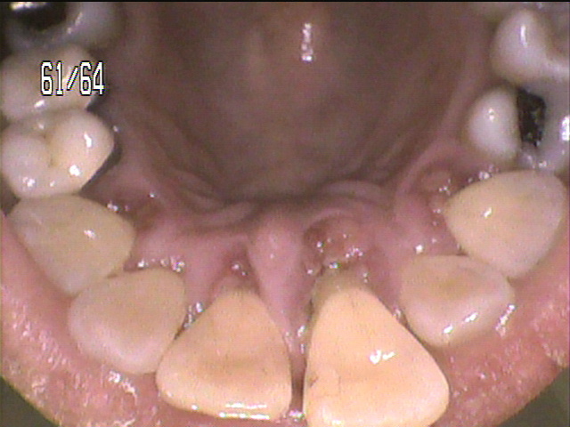 歯周病治療前　10_2