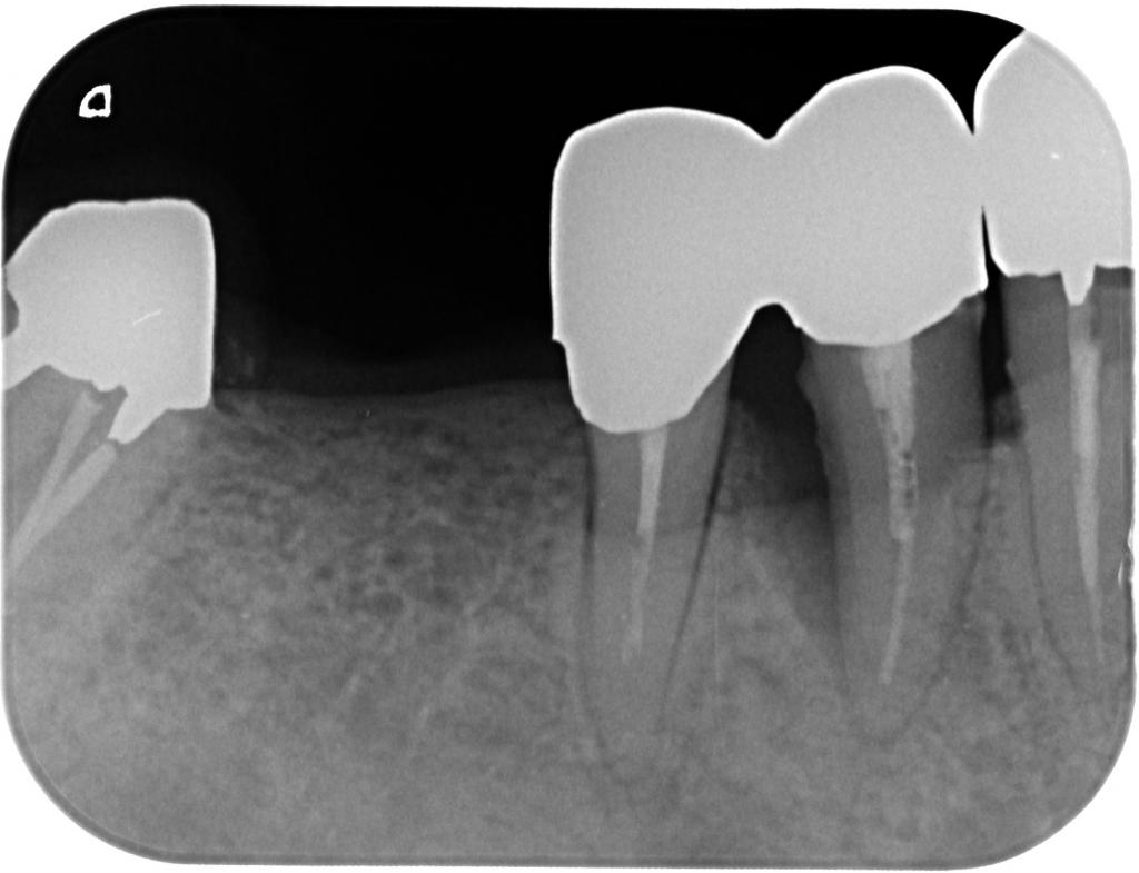 歯周病治療前　11_2