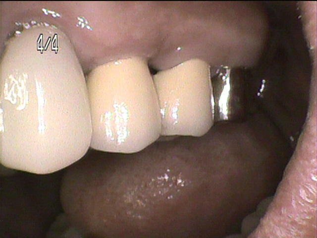 歯周病治療後　12_5