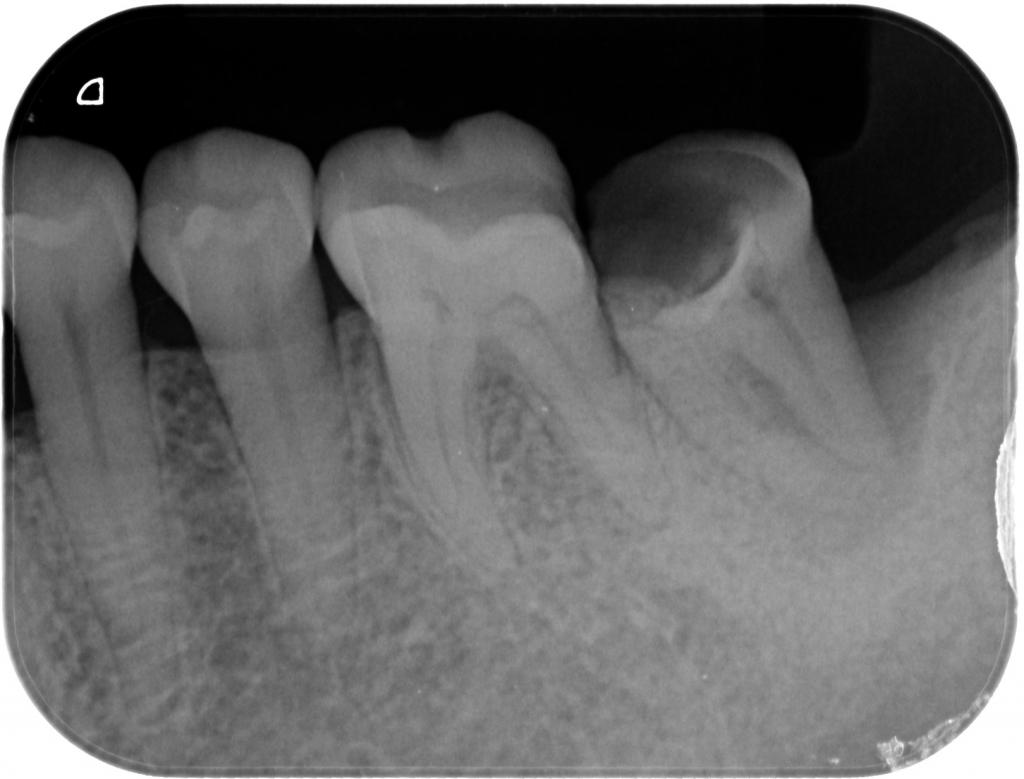 歯周病治療前　13_2