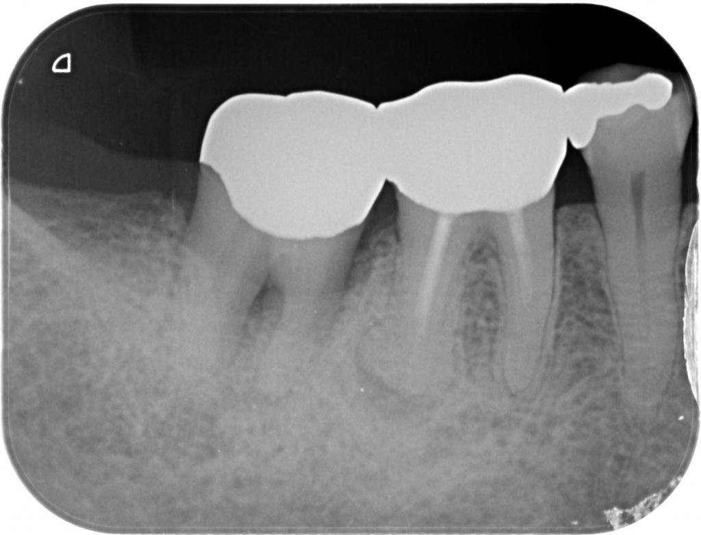 歯周病治療前　14_2