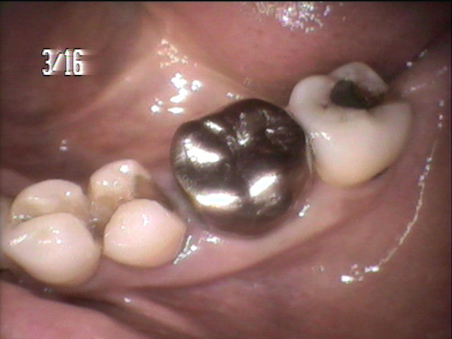 歯周病治療前　2_1