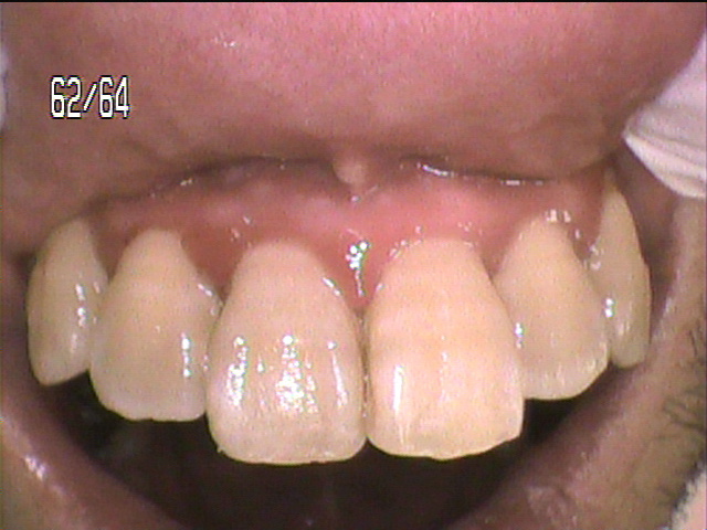 歯周病治療前　3_1