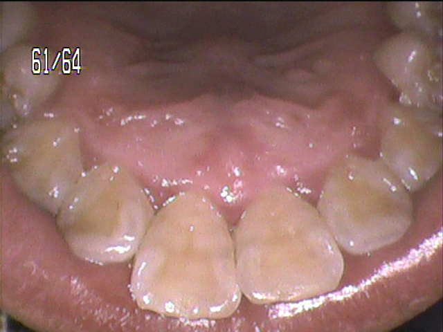 歯周病治療前　3_2