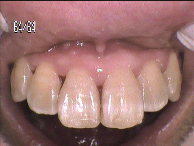 歯周病治療中　3_3