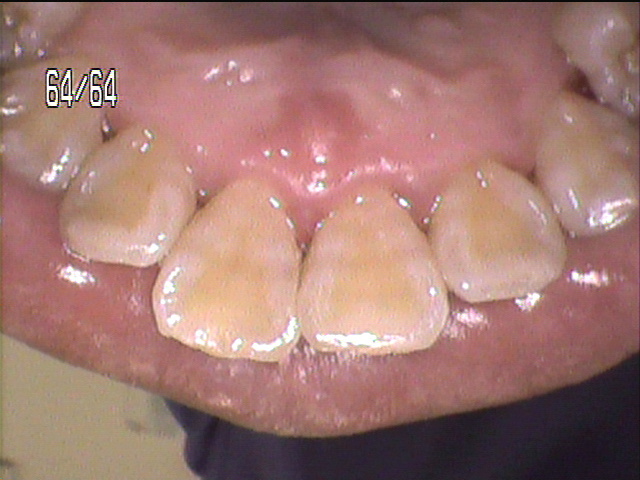 歯周病治療後　3_6