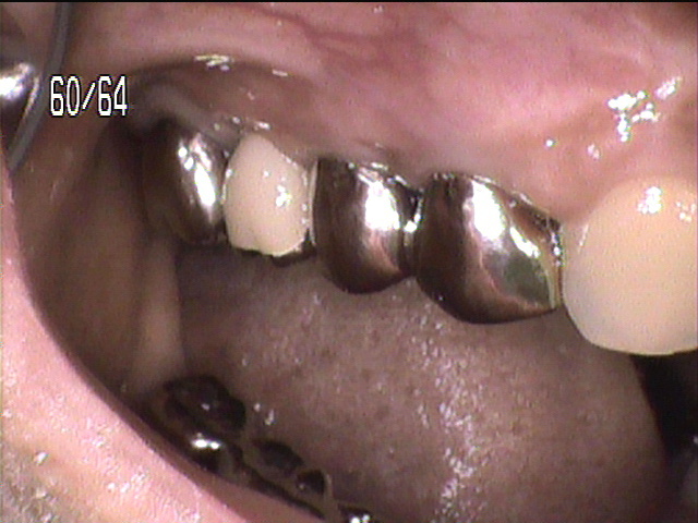 歯周病治療後　4_5