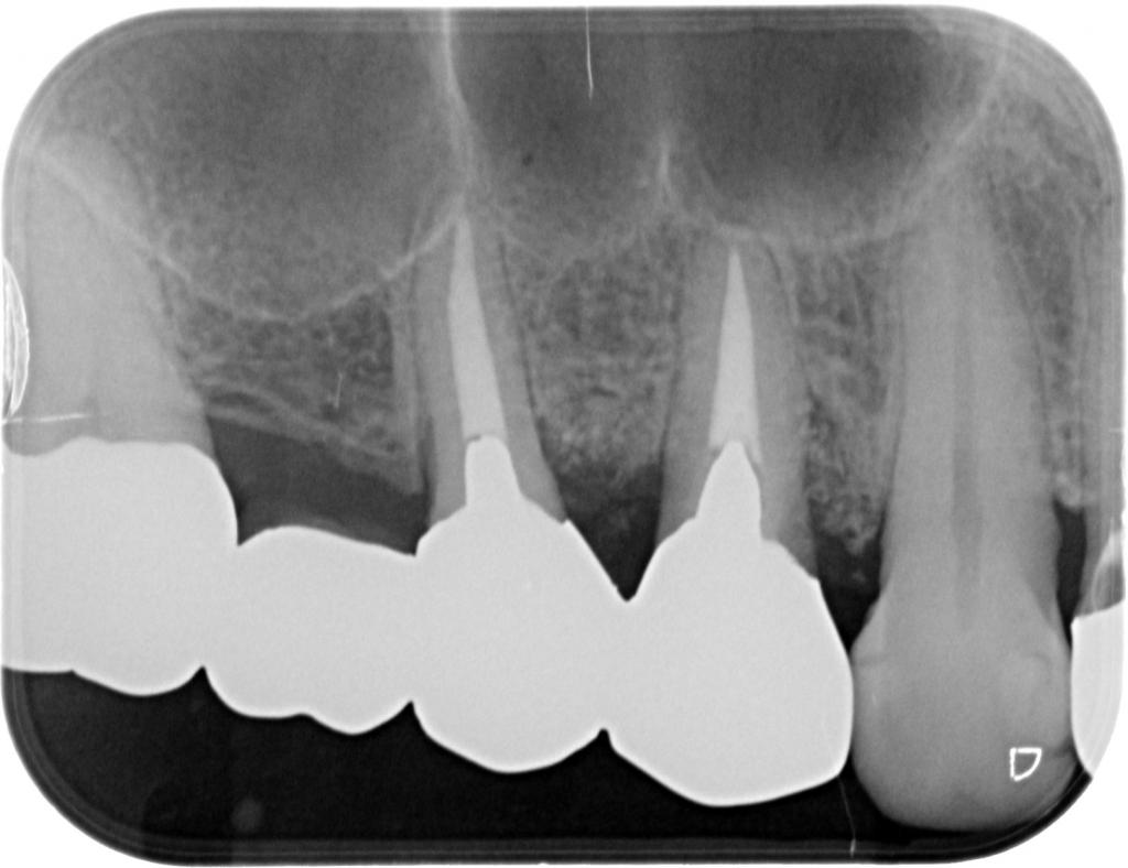歯周病治療後　4_6