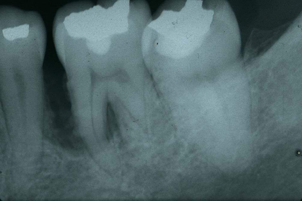 歯周病治療前　5_2