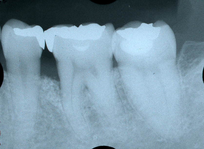 歯周病治療後　5_6