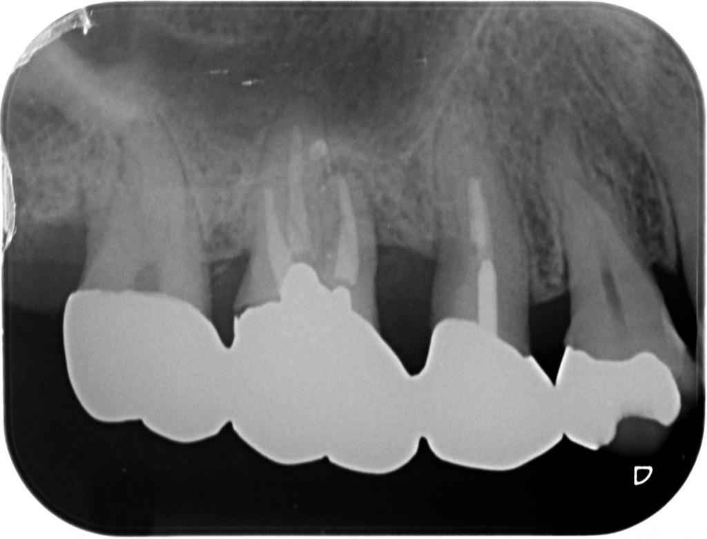 歯周病治療前　6_2