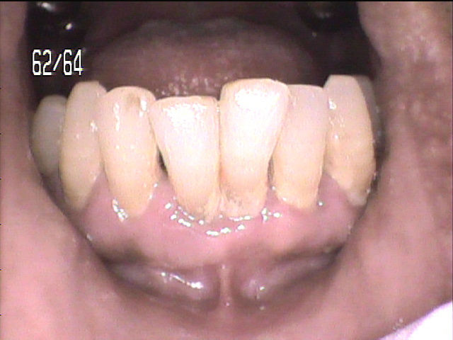 歯周病治療前　7_1