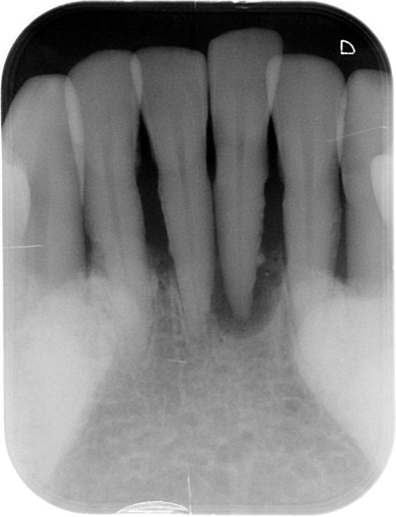 歯周病治療前　7_2