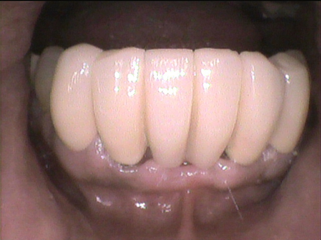 歯周病治療後　7_5