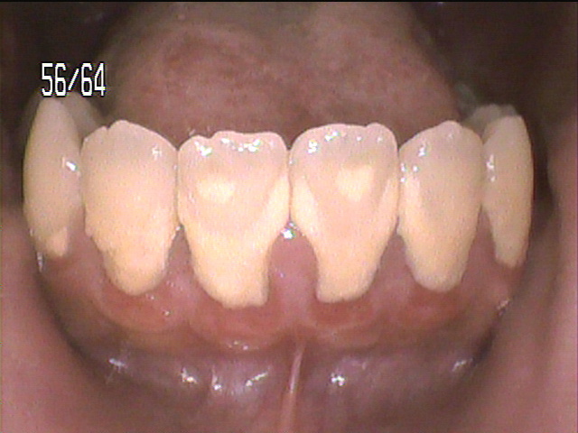 歯周病治療前　8_1