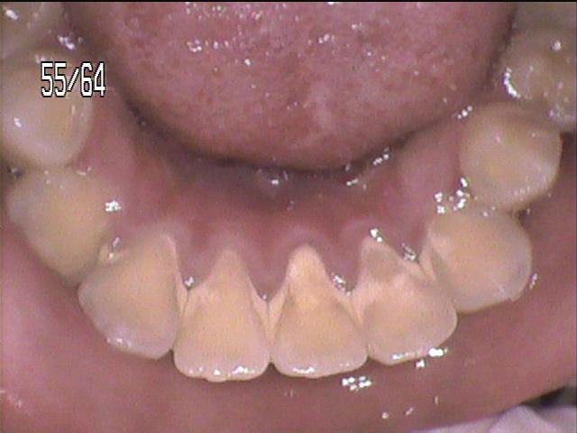 歯周病治療前　8_2