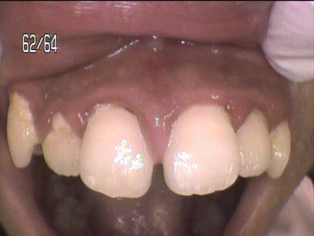 歯周病治療前　9_1