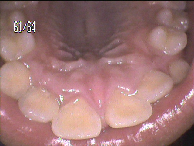 歯周病治療前　9_2